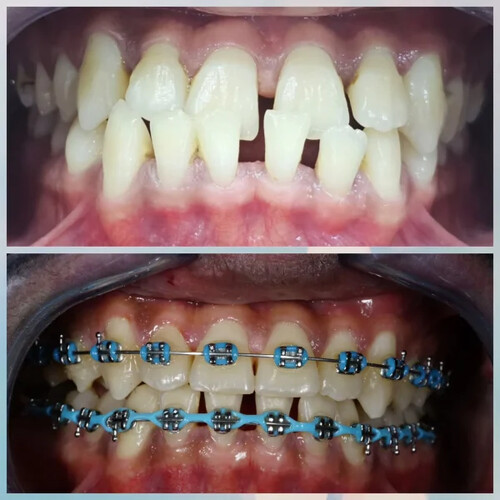 Braces treatment before and after