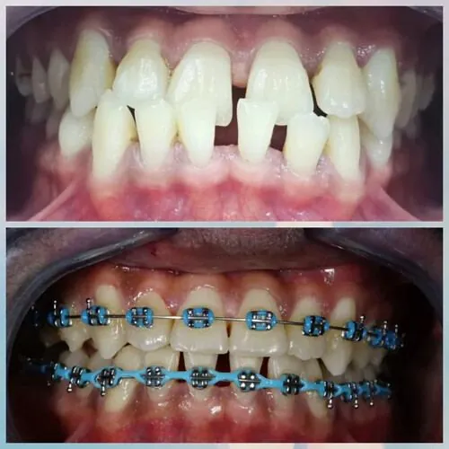 Braces treatment before and after