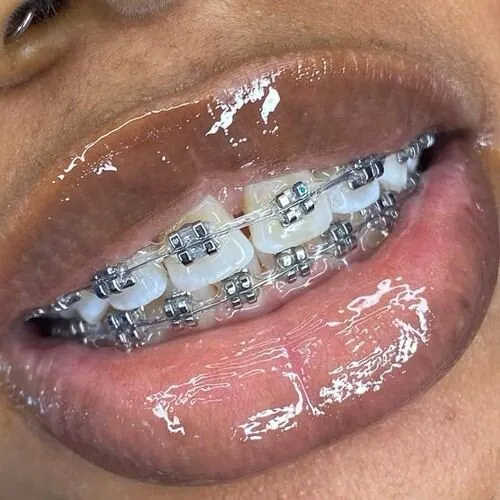 Orthodontic Braces Fitting at M Dental Care, Kampala
