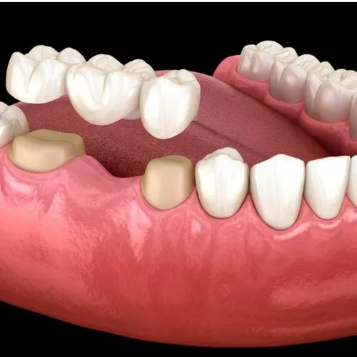 Dental bridge replacing a missing tooth at M Dental Care, Kampala