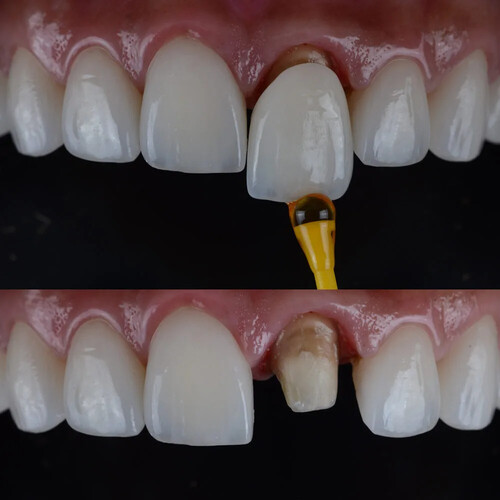 Dental crown preparation