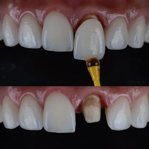 Repair of a broken front tooth at M Dental Care, Kampala
