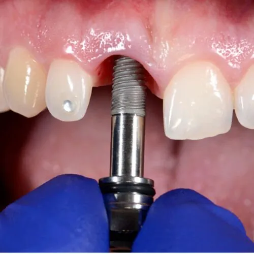 Dental implant replacing a missing tooth at M Dental Care, Kampala