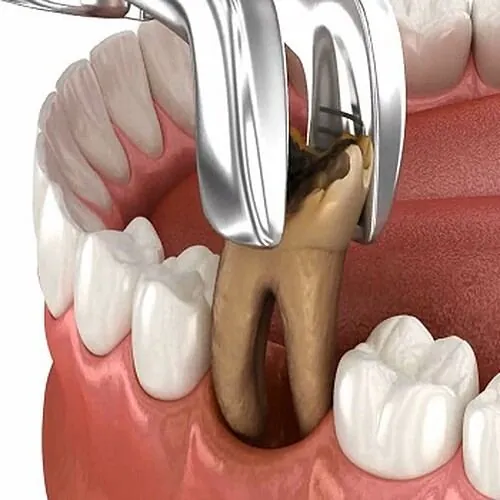 Tooth Extraction at M Dental Care, Kampala