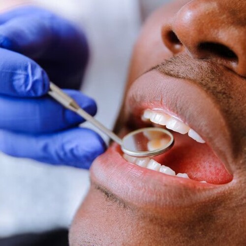 Dental composite filling