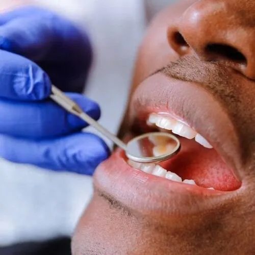 Cavity treated with a tooth-coloured filling at M Dental Care, Kampala