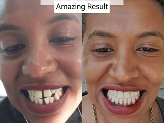 Orthodontic braces before and after