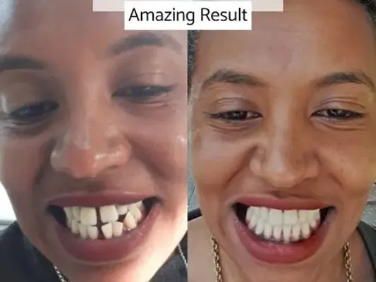Orthodontic braces before and after