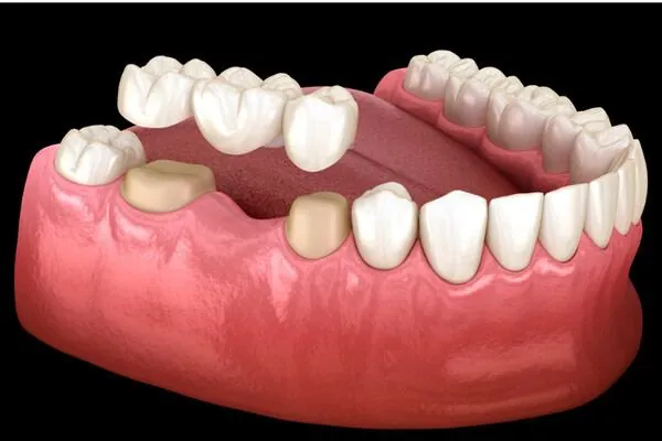 Dental crown restoration