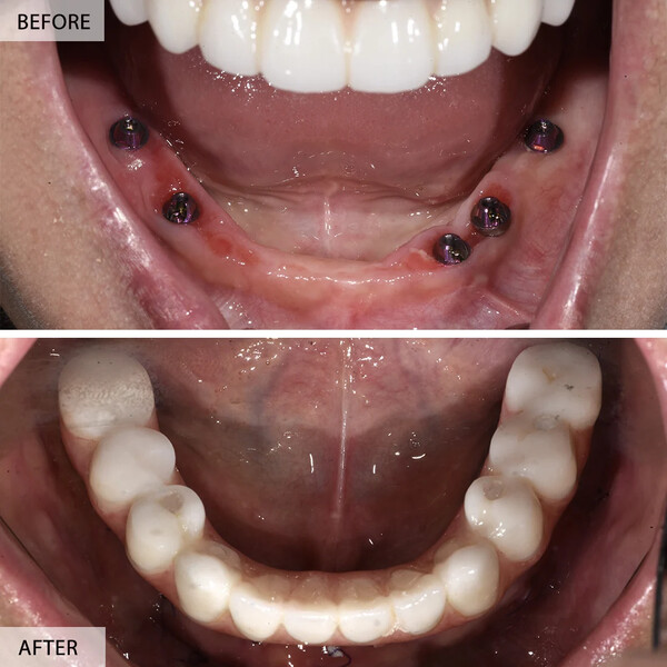 Dental implants before and after