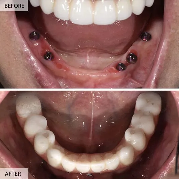 Dental implants before and after