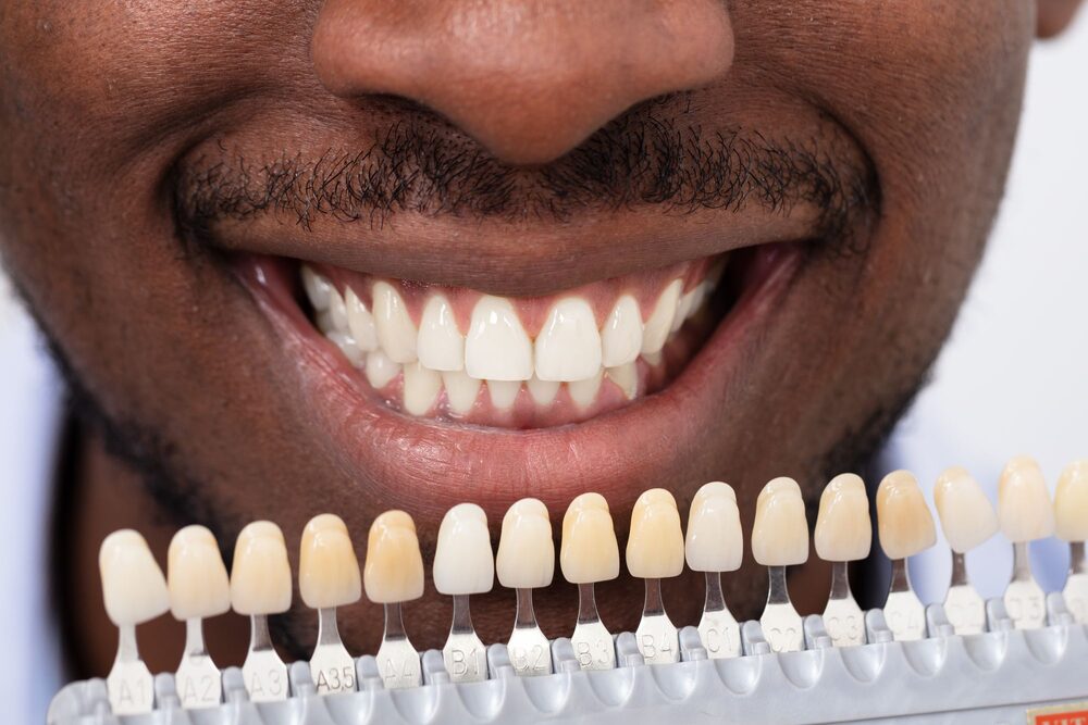 Smile makeover with veneer shade matching