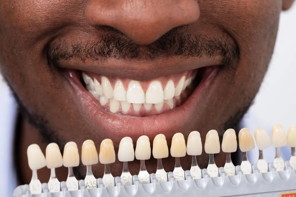 Smile makeover with veneer shade matching
