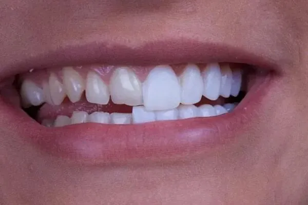 Veneer transformation result