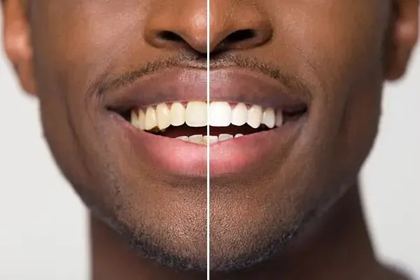 Teeth whitening before and after