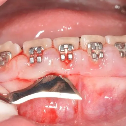 Oral surgery — gum treatment with braces