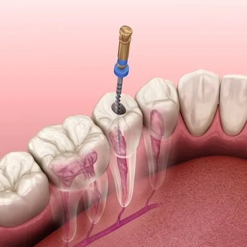 Root Canal (Endodontic) Treatment at M Dental Care, Kampala