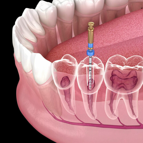 Endodontic root canal procedure