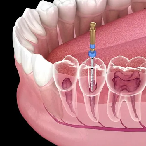 Endodontic root canal procedure