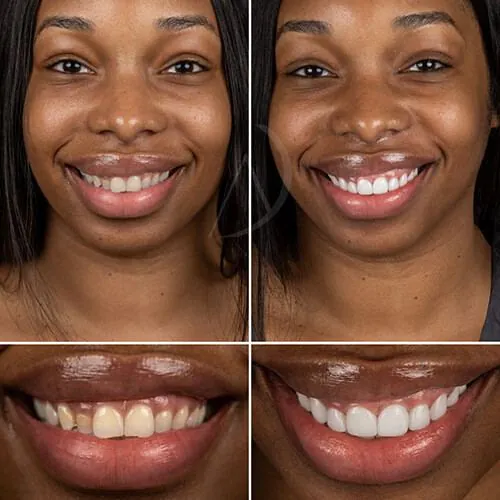 Smile makeover before and after