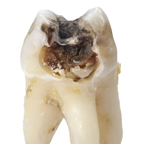 Extracted tooth
