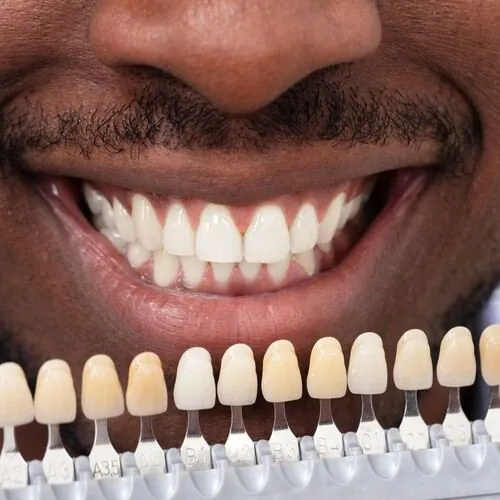 Smile with porcelain veneer shade matching