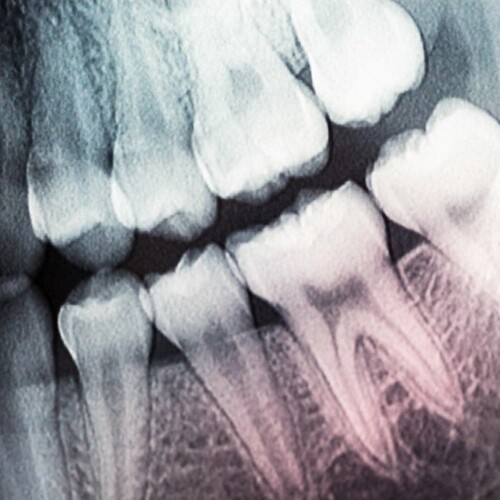 Dental X-ray showing teeth and roots